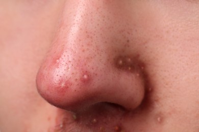Photo of Young man with acne problem, closeup view of nose