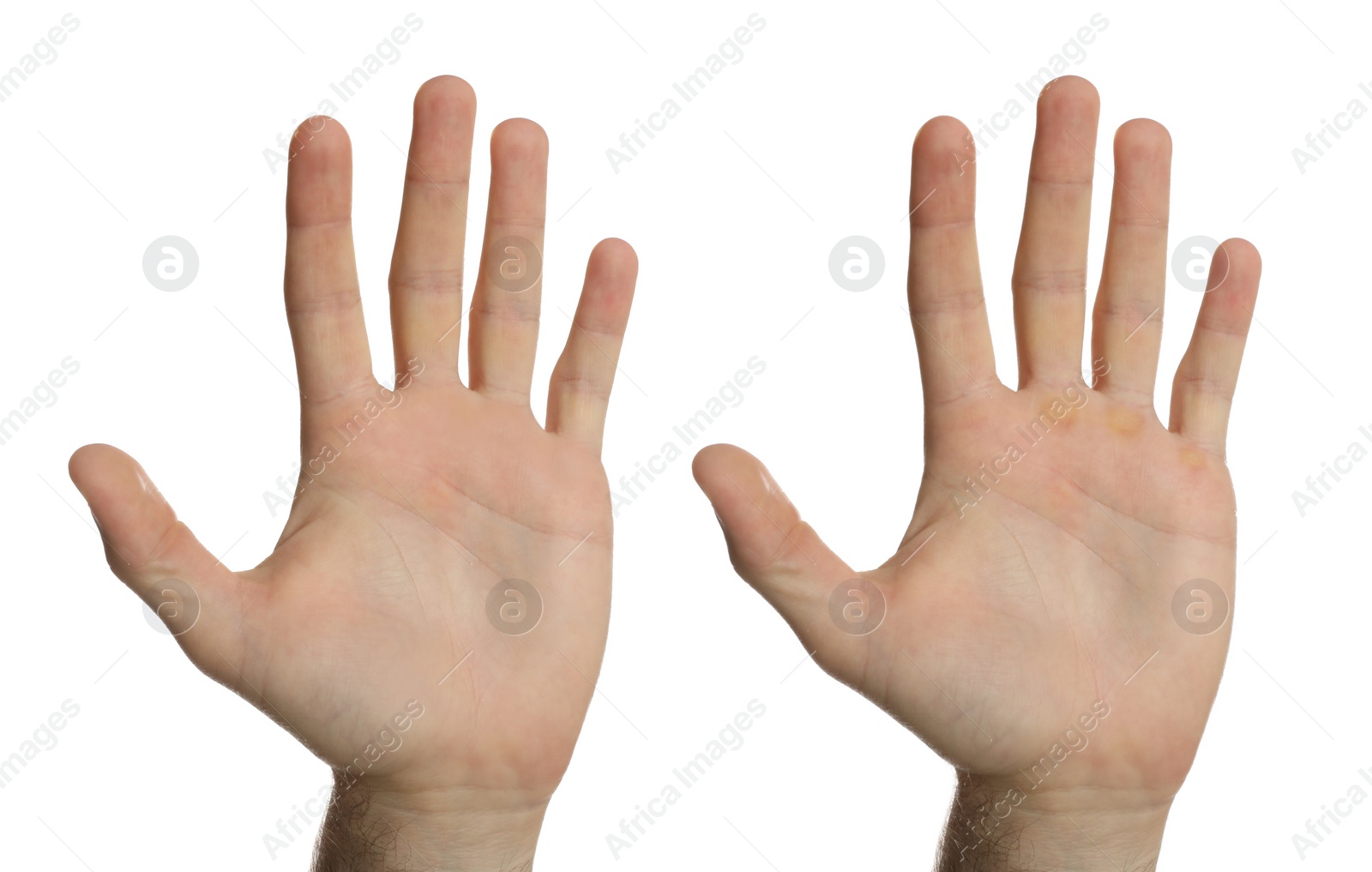 Image of Man showing hands without and with calluses on white background., closeup. Collage 