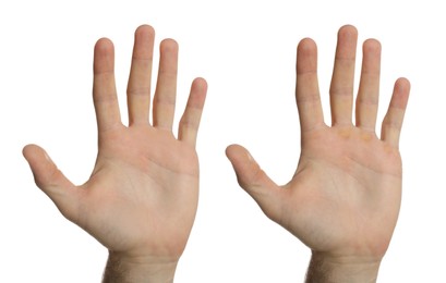 Man showing hands without and with calluses on white background., closeup. Collage 