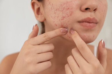 Photo of Teen girl with acne problem squeezing pimple on her face, closeup