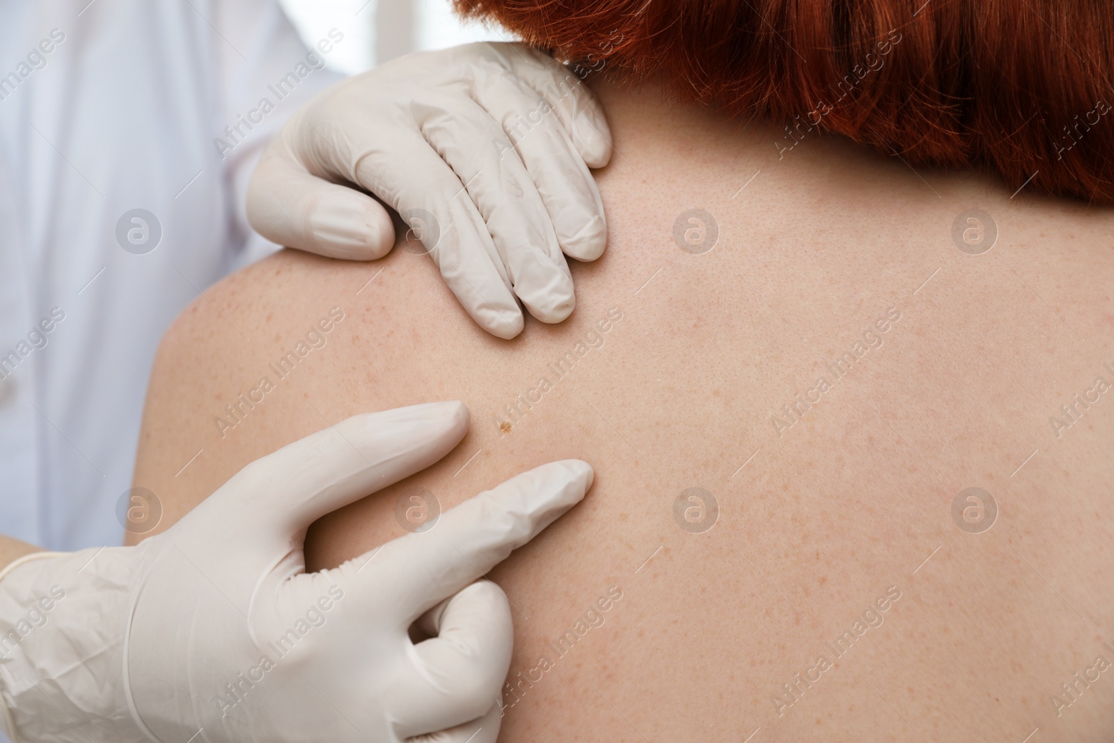 Photo of Dermatologist examining patient's birthmark in clinic, closeup view