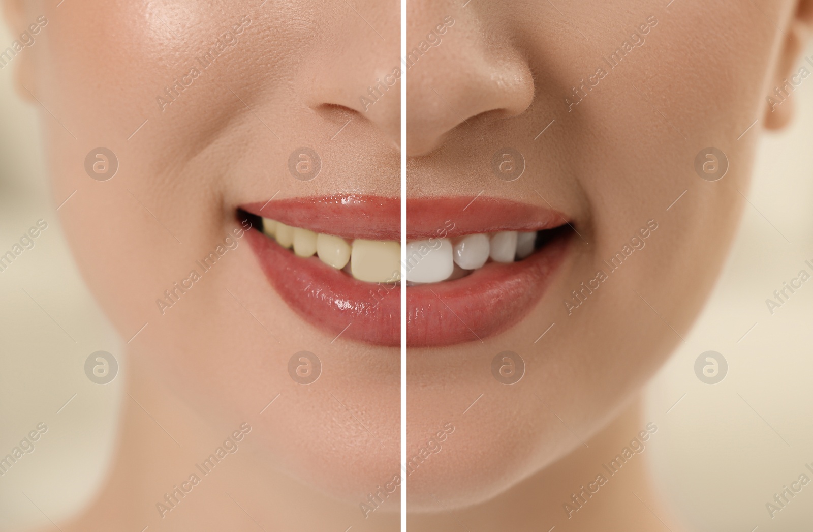 Image of Photo of woman divided in halves before and after tooth whitening, closeup. Collage design