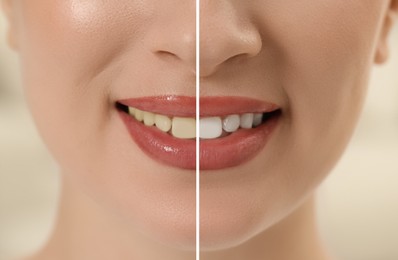 Image of Photo of woman divided in halves before and after tooth whitening, closeup. Collage design