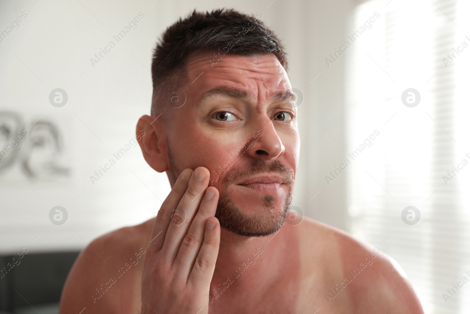 Photo of Man with sunburn on skin at home