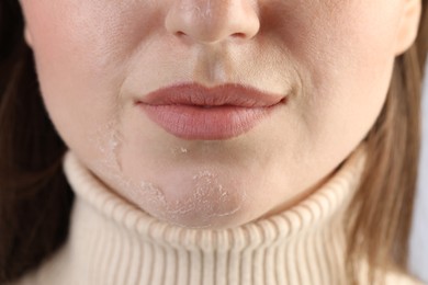 Closeup view of woman with dry skin