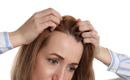 Photo of Woman suffering from baldness on white background, closeup