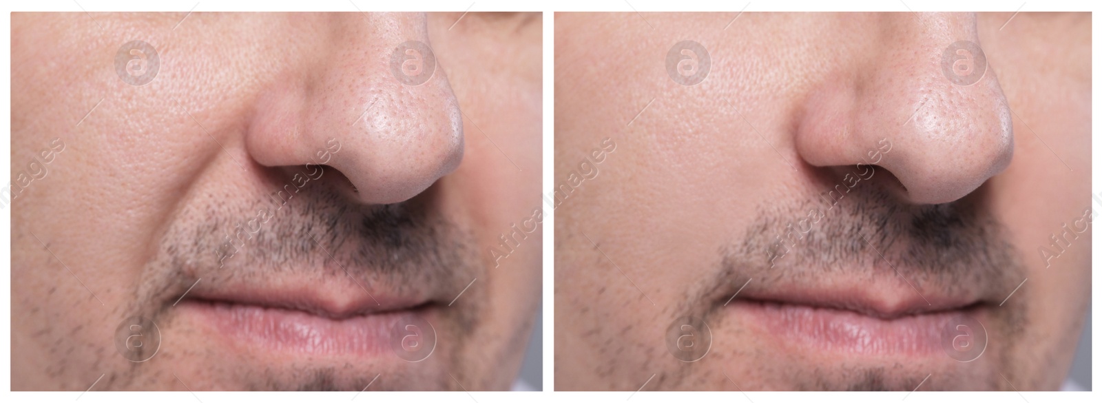 Image of Aging skin changes. Man showing face before and after rejuvenation, closeup. Collage comparing skin condition