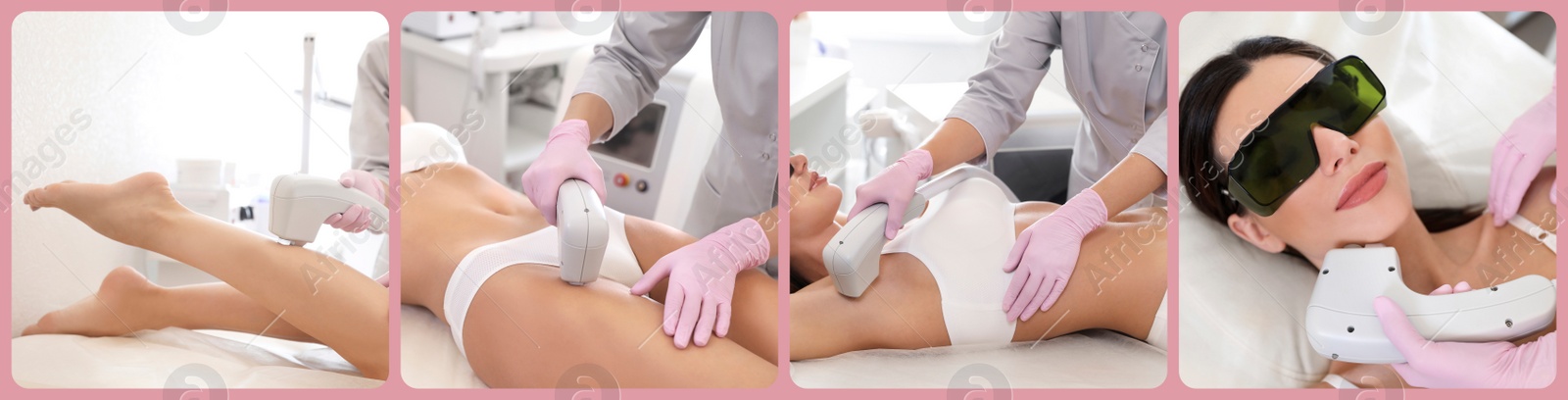 Image of Collage with photos of woman undergoing laser epilation procedure. Banner design