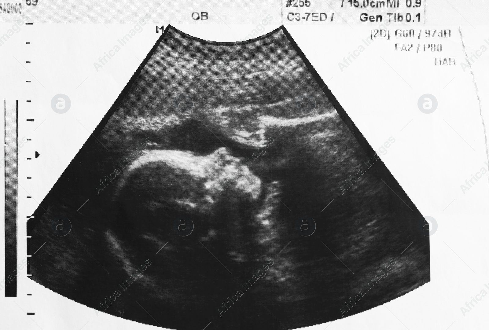 Photo of Ultrasound photo of unborn baby in mother's womb, closeup view