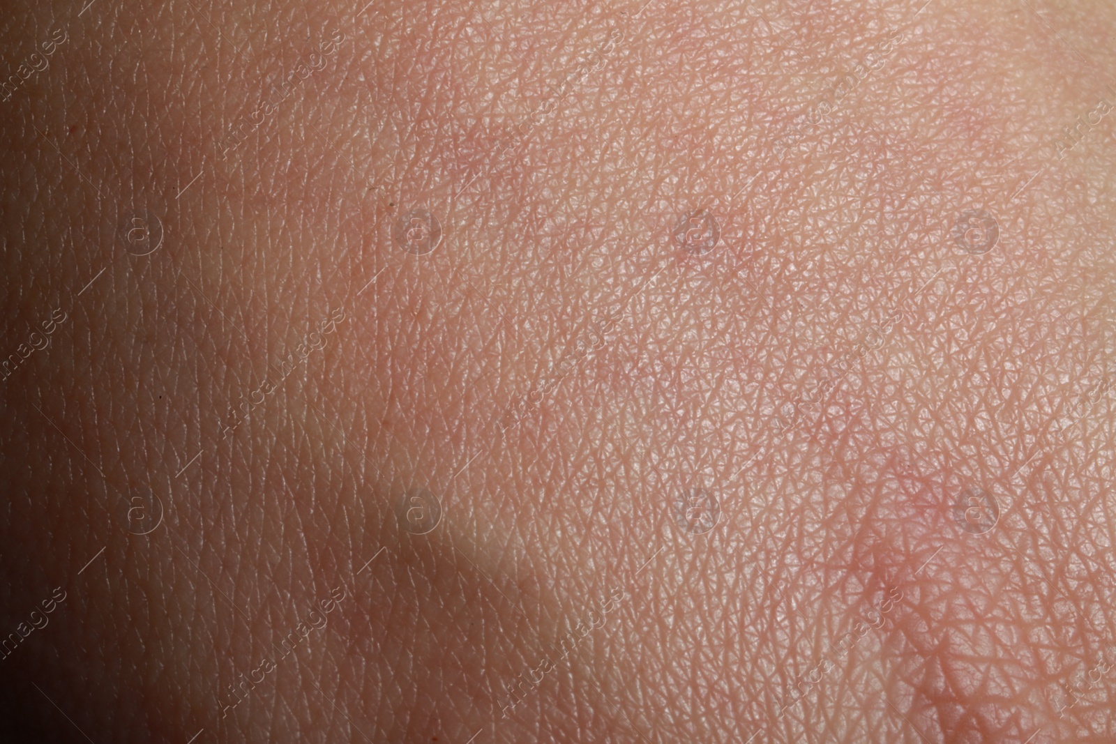 Photo of Closeup view of dry human skin as background