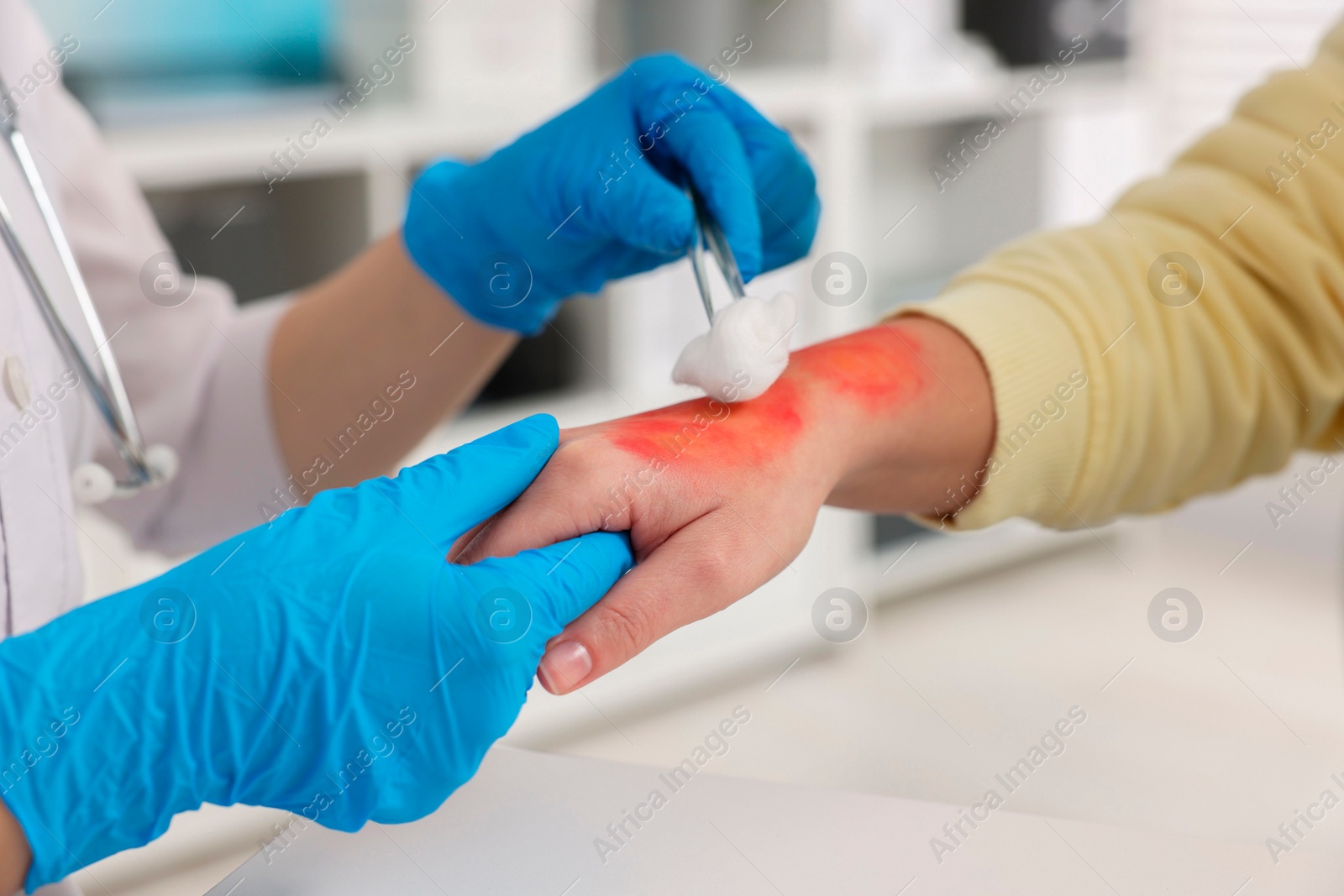 Photo of Doctor treating patient's burned hand in hospital, closeup