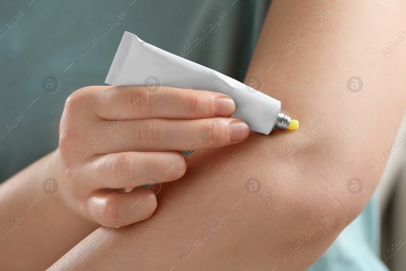 Photo of Woman applying ointment from tube onto her arm, closeup