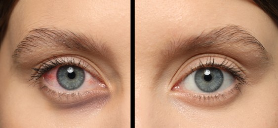 Image of Collage with photos of woman with inflamed and healthy eyes before and after treatment, closeup. Banner design