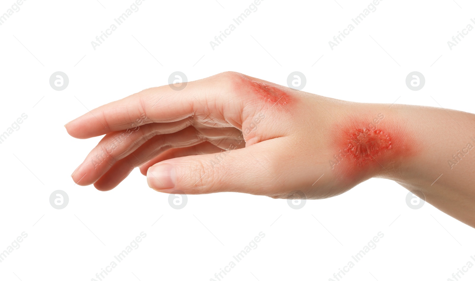 Photo of Woman with burned hand on white background, closeup