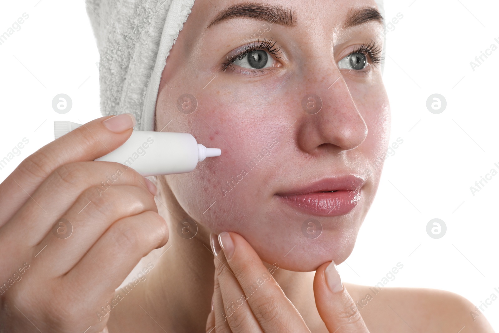 Photo of Young woman with acne problem applying cosmetic product onto her skin on white background, closeup