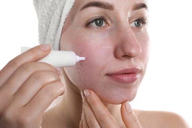 Photo of Young woman with acne problem applying cosmetic product onto her skin on white background, closeup