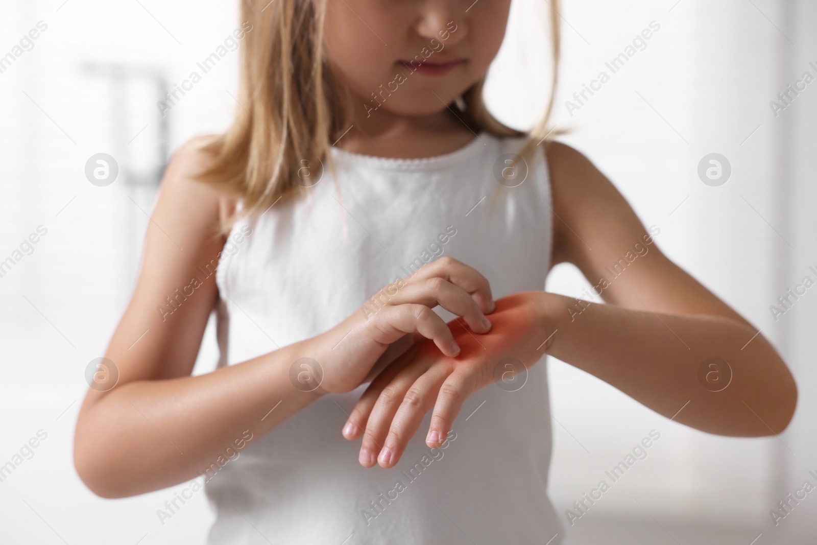 Photo of Suffering from allergy. Little girl scratching her hand indoors, closeup