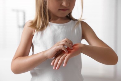 Photo of Suffering from allergy. Little girl scratching her hand indoors, closeup