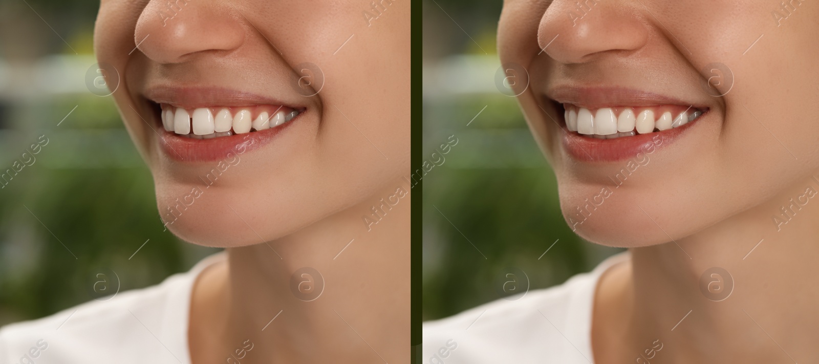 Image of Collage with photos of woman with diastema between upper front teeth before and after treatment on blurred background, closeup. Banner design