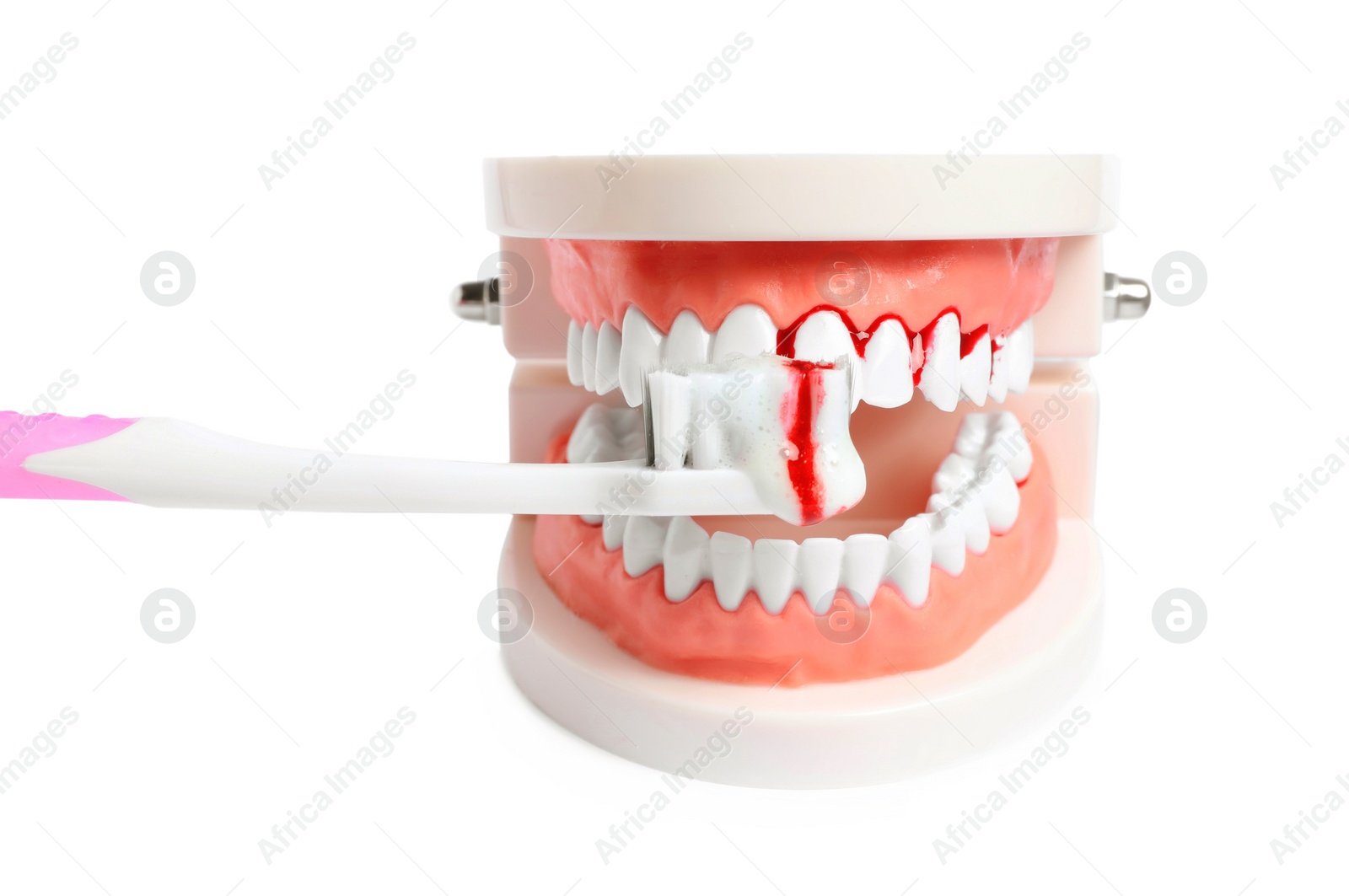 Photo of Model of jaw, brush and toothpaste foam with blood on white background. Gum problems