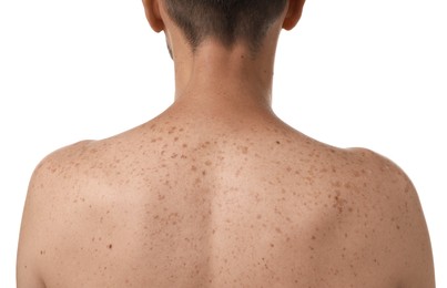 Photo of Closeup of man`s body with birthmarks on white background, back view