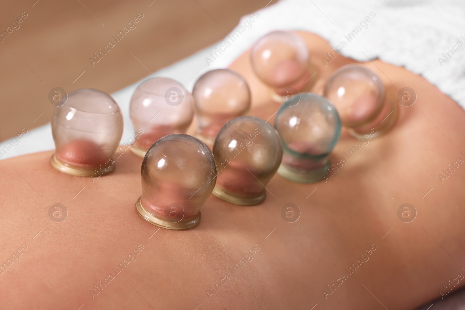 Photo of Cupping therapy. Closeup view of woman with glass cups on her back indoors