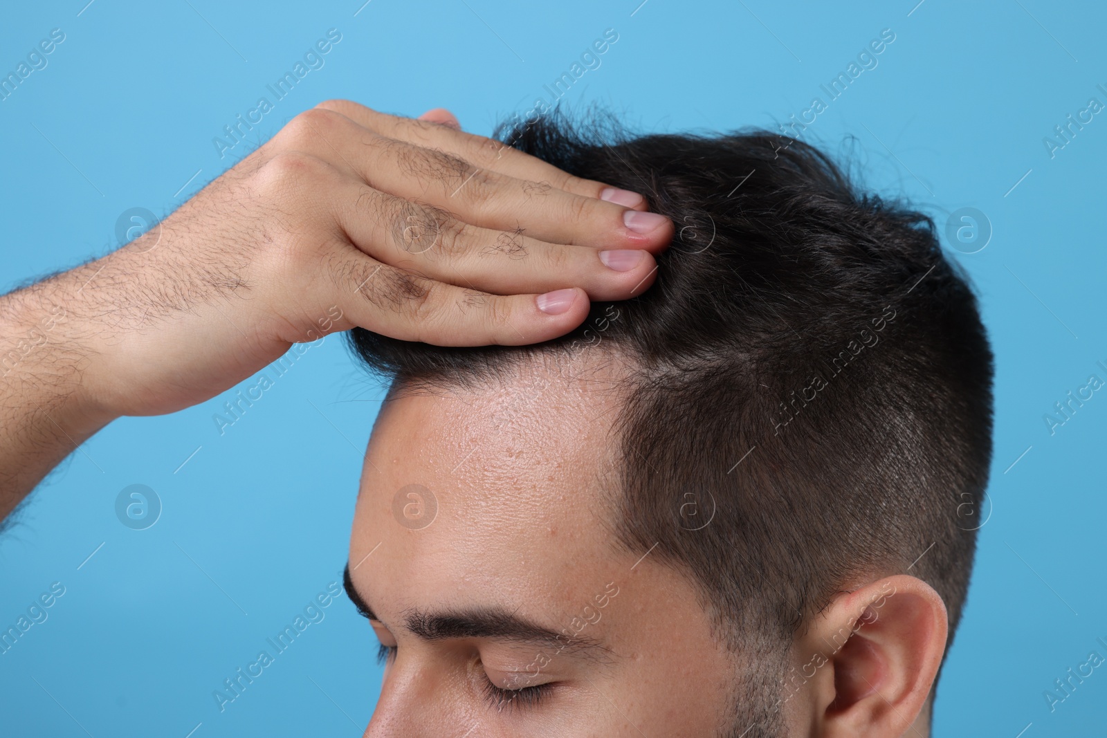 Photo of Man examining his head on light blue background, closeup. Dandruff problem