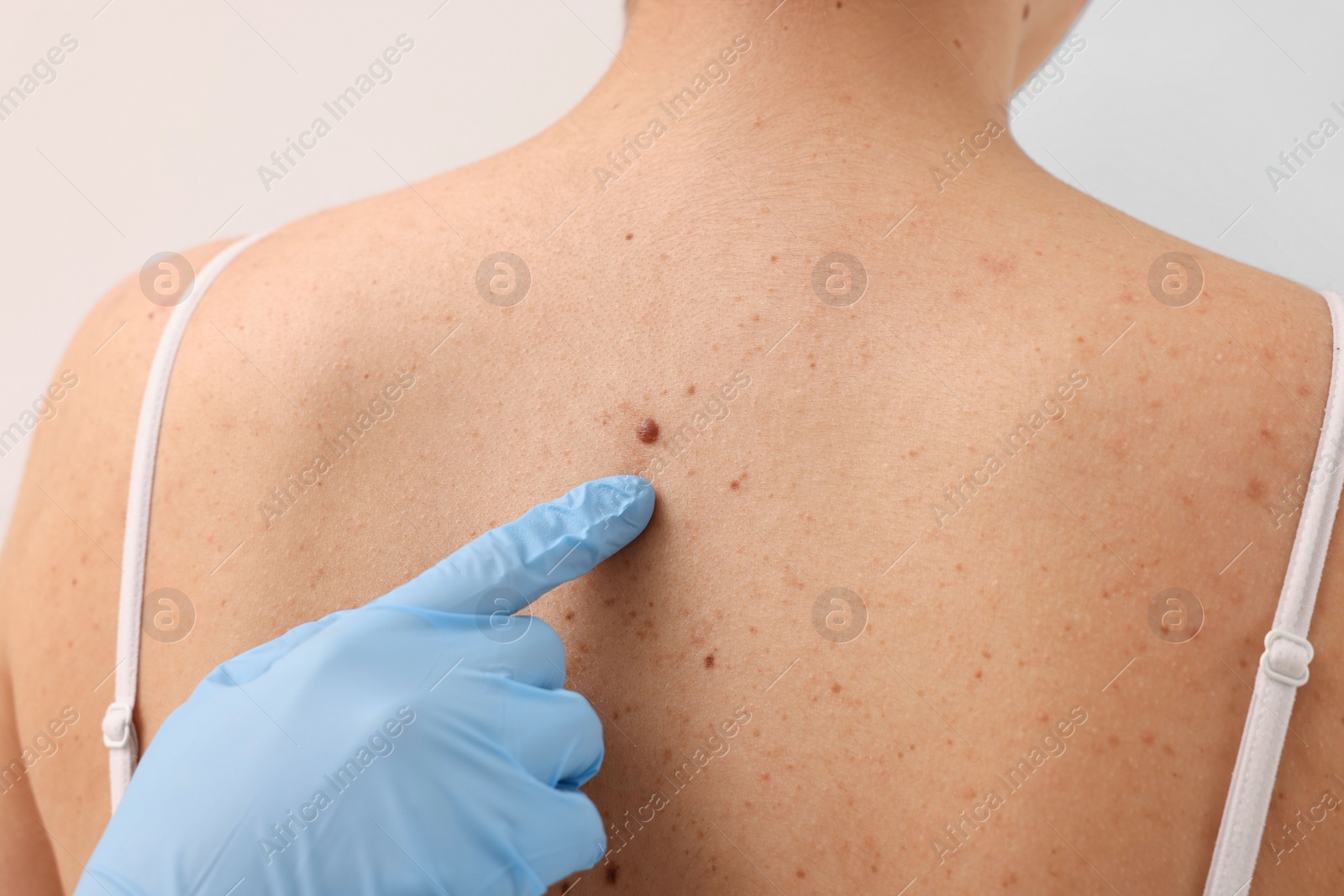 Photo of Dermatologist in rubber glove examining patient's birthmark, closeup view