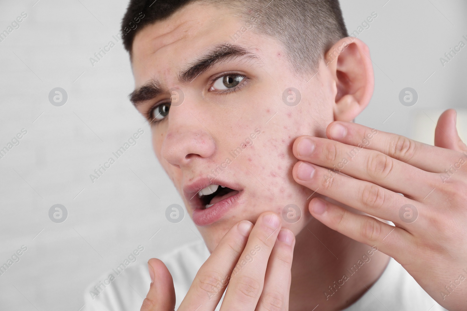 Photo of Upset young man touching pimple on his face indoors. Acne problem