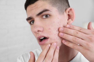 Photo of Upset young man touching pimple on his face indoors. Acne problem