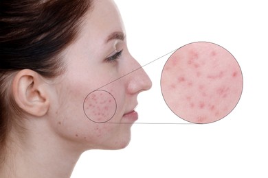 Dermatology. Woman with skin problem on white background. Zoomed area showing acne