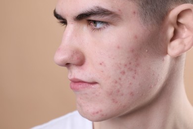 Young man with acne problem on beige background, closeup