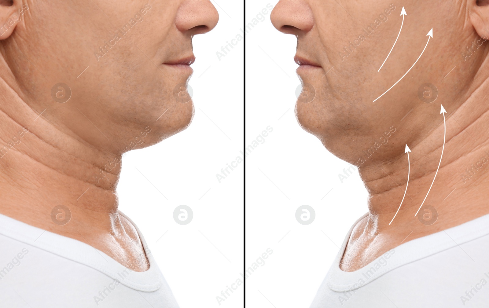 Image of Mature man before and after plastic surgery operation on white background, closeup. Double chin problem 