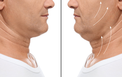 Image of Mature man before and after plastic surgery operation on white background, closeup. Double chin problem 