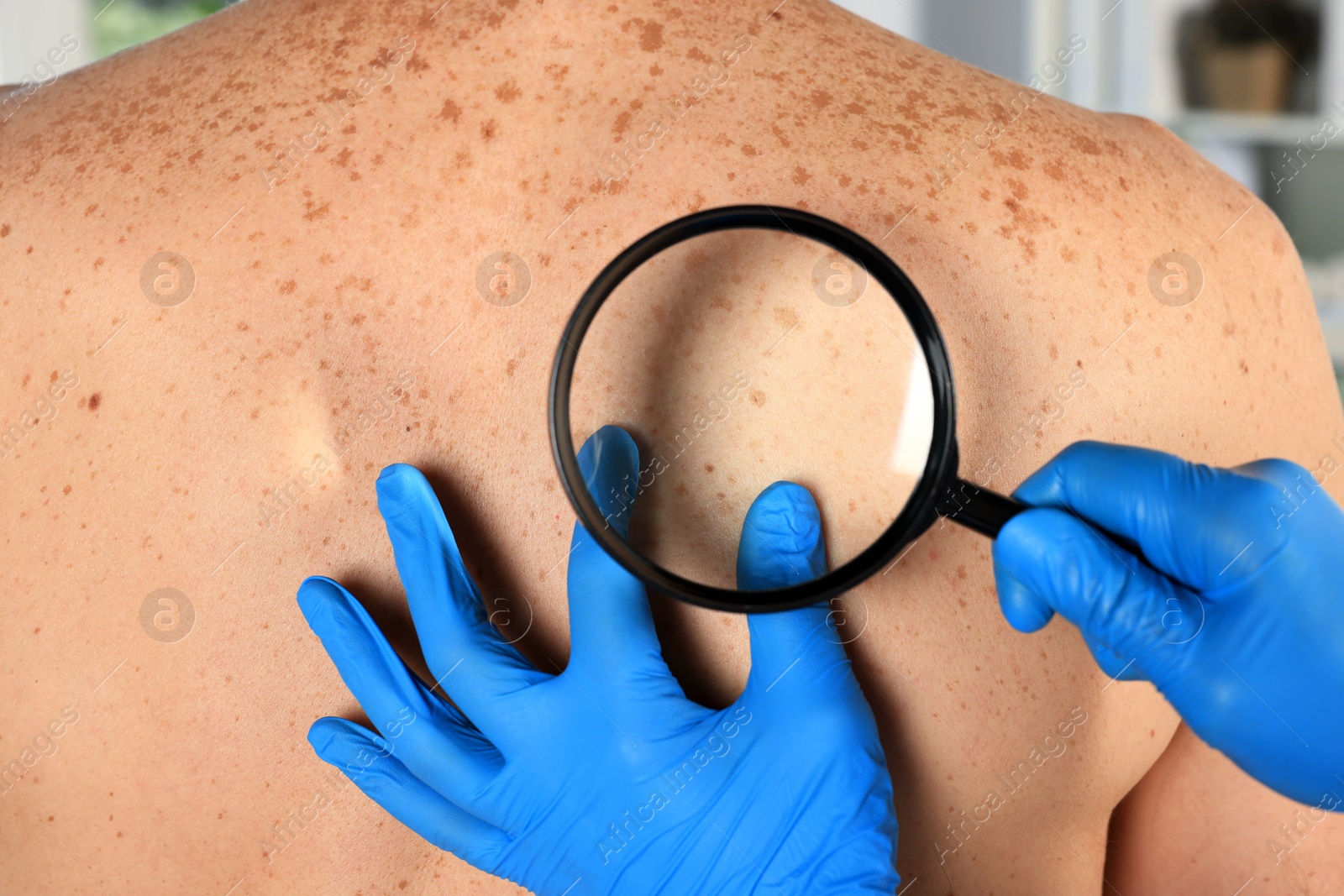 Photo of Dermatologist examining patient's birthmark with magnifying glass, closeup