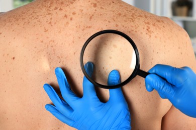 Dermatologist examining patient's birthmark with magnifying glass, closeup