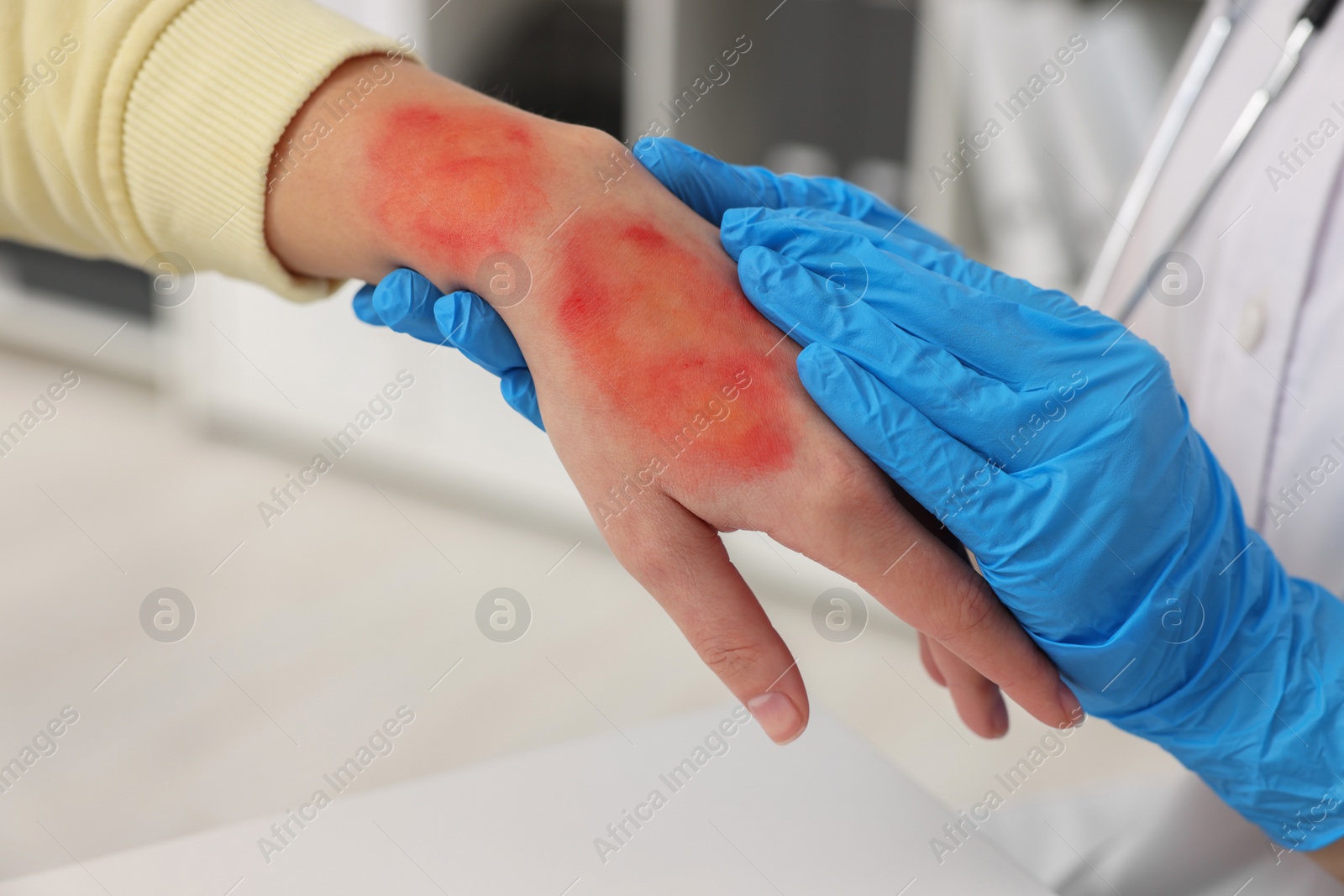 Photo of Doctor examining patient's burned hand indoors, closeup