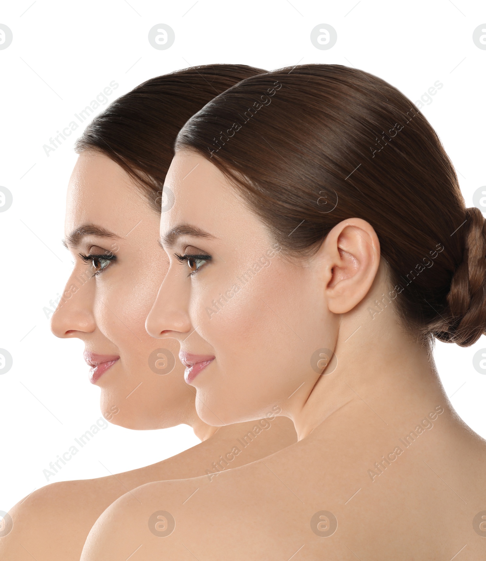 Image of Double chin problem. Collage with photos of young woman before and after plastic surgery procedure on white background