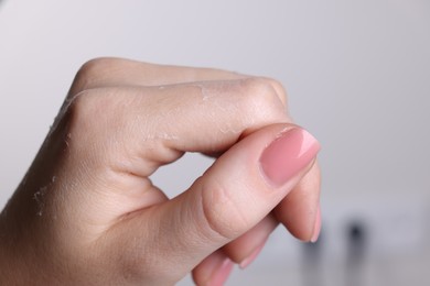 Photo of Woman with dry skin on hand against light background, macro view