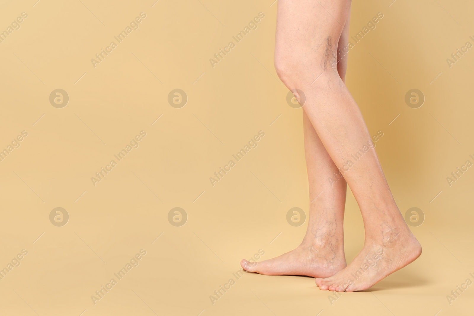 Photo of Closeup view of woman with varicose veins on yellow background. Space for text