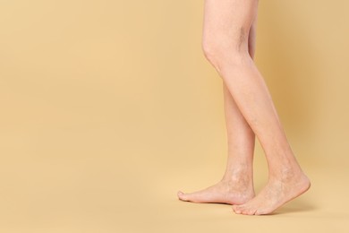 Closeup view of woman with varicose veins on yellow background. Space for text