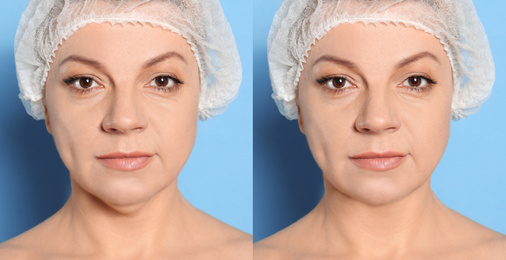Image of Mature woman before and after plastic surgery operation on blue background. Double chin problem