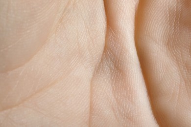 Photo of Closeup view of human hand with dry skin