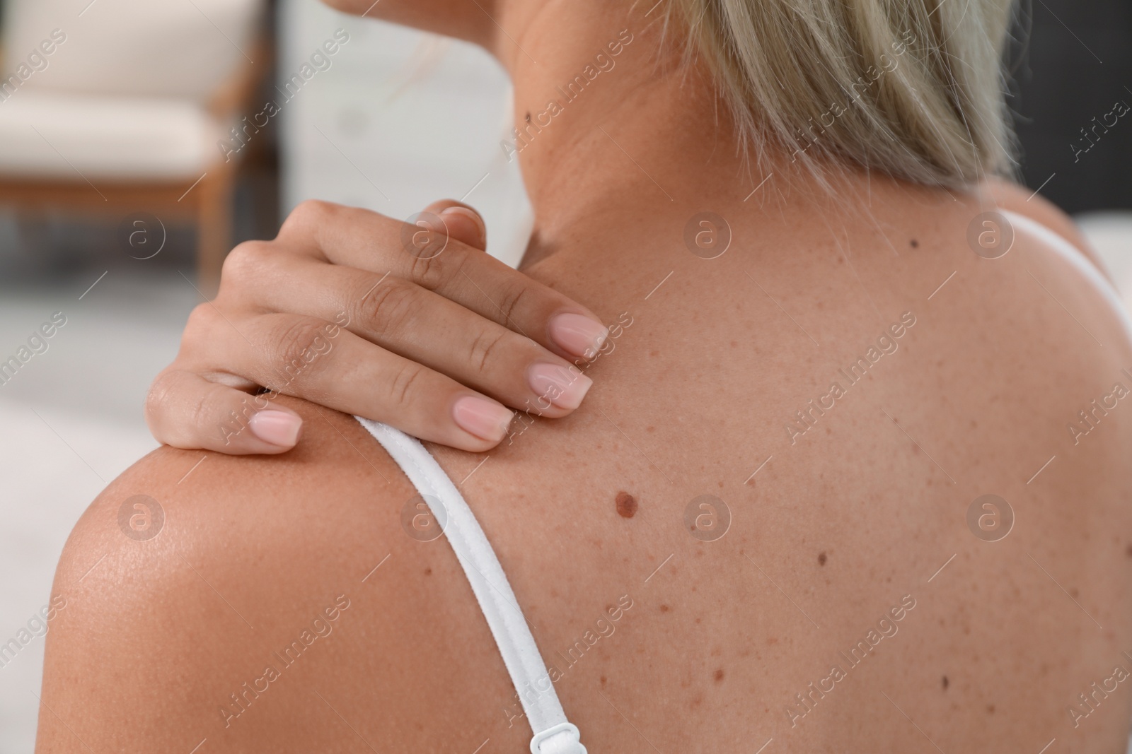 Photo of Closeup view of woman`s body with birthmarks indoors