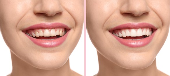 Image of Collage with photos of woman before and after teeth whitening, closeup. Banner design
