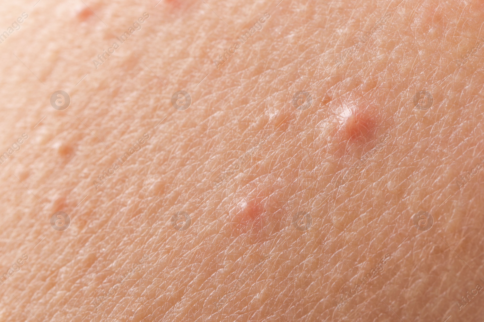 Photo of Young person with acne problem, closeup view of skin