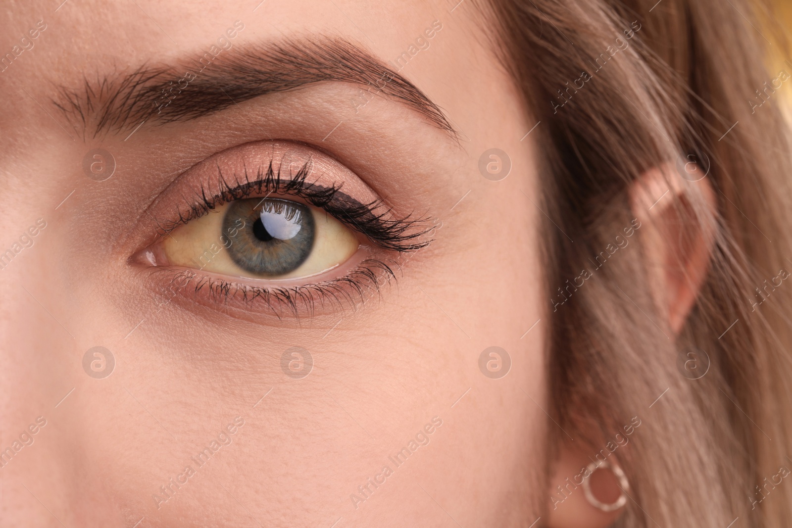 Photo of Woman with yellow eyes, closeup. Liver problems symptom