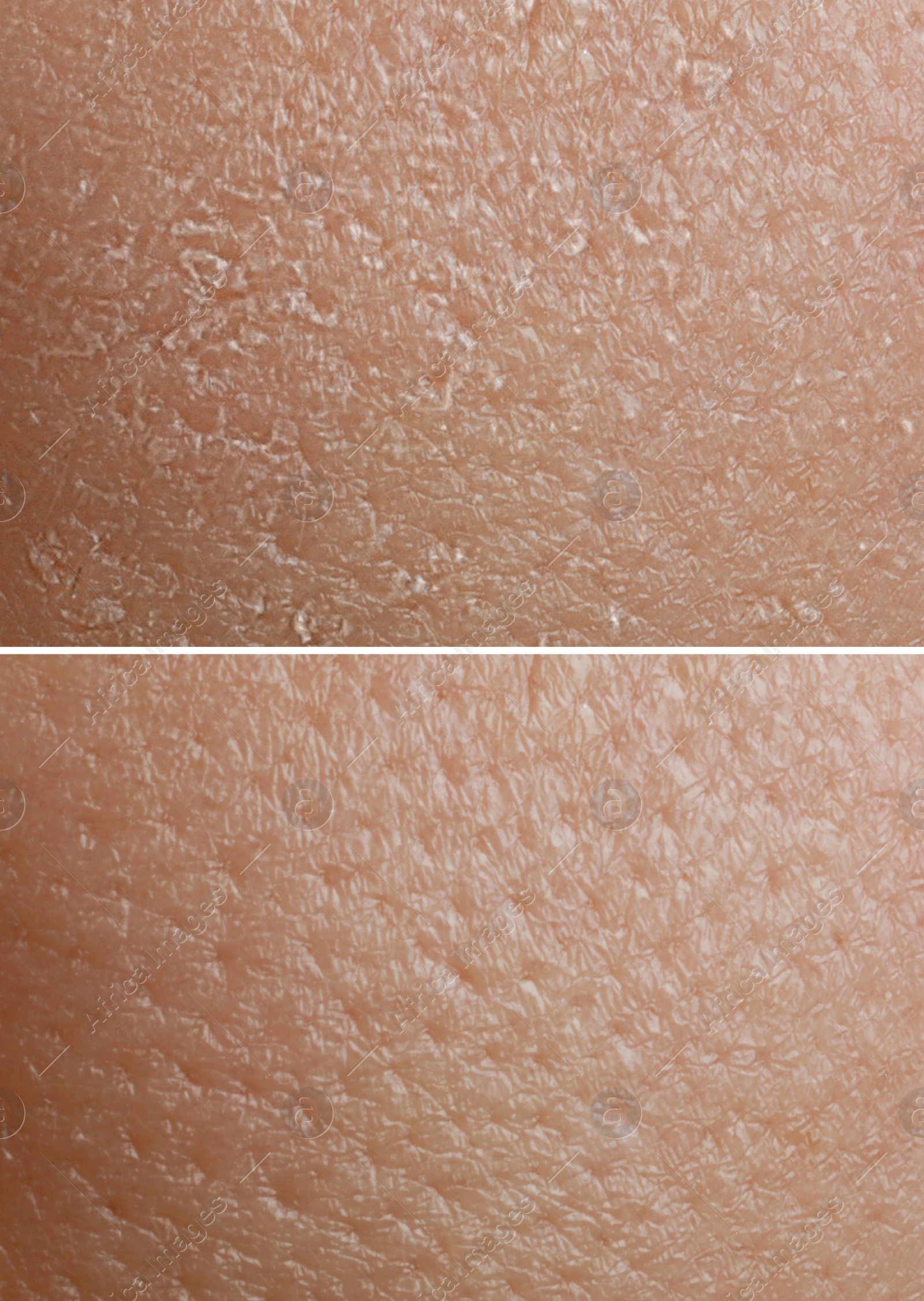 Image of Collage demonstrating comparison of dry and moisturized human skin, closeup