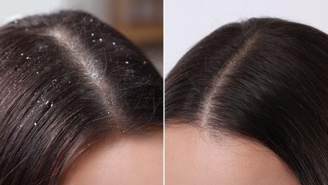 Woman showing hair before and after dandruff treatment, collage