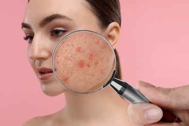 Image of Dermatologist looking at woman's face with magnifying glass on pink background, closeup. Zoomed view on acne